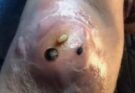 Big Cystic Acne Blackheads Extraction Blackheads & Milia, Whiteheads Removal Pimple Popping